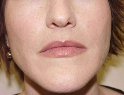 Lip Augmentation Before & After Patient #318
