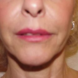 Lip Augmentation Before & After Patient #321