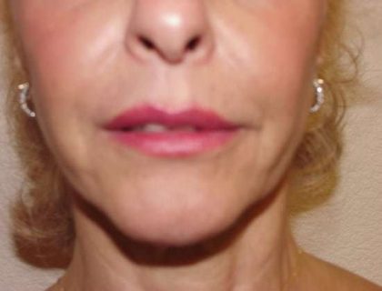 Lip Augmentation Before & After Patient #321