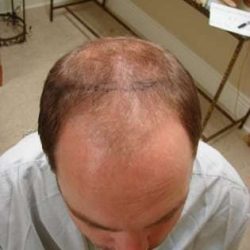 Hair Transplants Before & After Patient #328