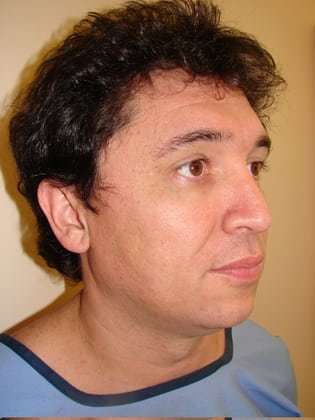 Facial Implants Before & After Patient #337