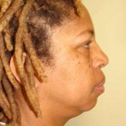 Facial Implants Before & After Patient #343