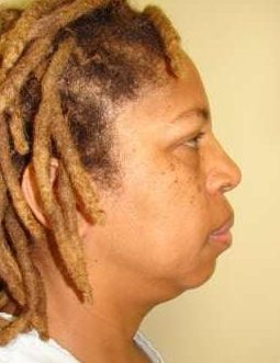 Facial Implants Before & After Patient #343