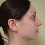 Facial Implants Before & After Patient #346