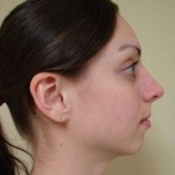 Facial Implants Before & After Patient #346
