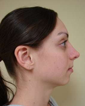 Facial Implants Before & After Patient #346