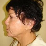 Facelift Before & After Patient #353