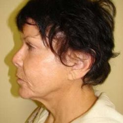 Facelift Before & After Patient #353