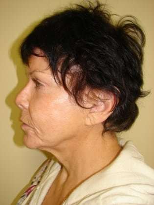 Facelift Before & After Patient #353
