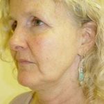 Facelift Before & After Patient #358