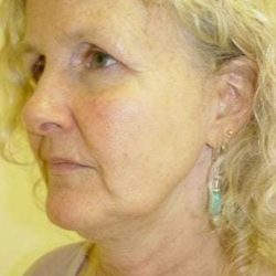 Facelift Before & After Patient #358