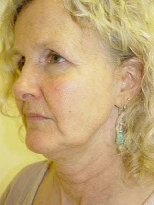 Facelift Before & After Patient #358
