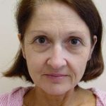 Facelift Before & After Patient #361