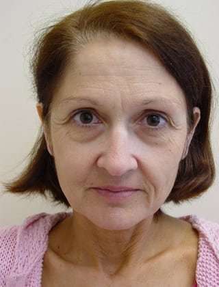 Facelift Before & After Patient #361