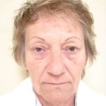 Facelift Before & After Patient #365