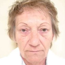Facelift Before & After Patient #365