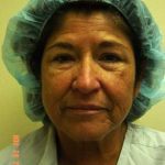 Facelift Before & After Patient #372