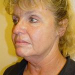 Facelift Before & After Patient #375