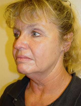 Facelift Before & After Patient #375