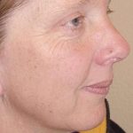 Laser Resurfacing Before & After Patient #146