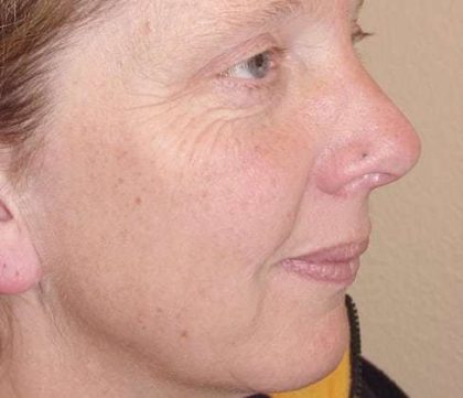 Laser Resurfacing Before & After Patient #146