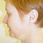 Facelift Before & After Patient #379