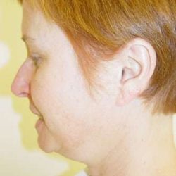 Facelift Before & After Patient #379