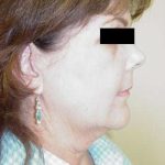 Facelift Before & After Patient #384