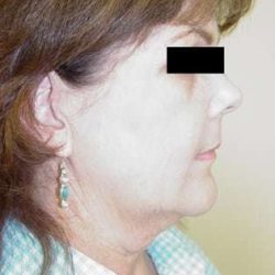 Facelift Before & After Patient #384