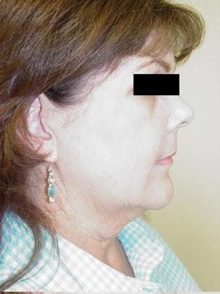 Facelift Before & After Patient #384