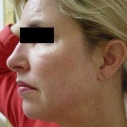Facelift Before & After Patient #387
