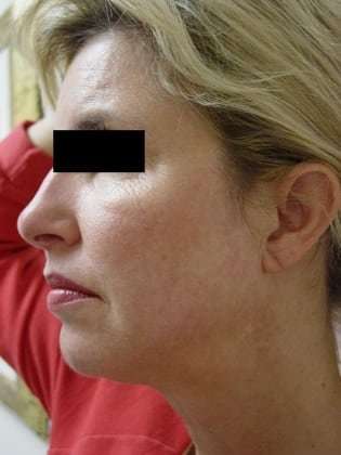 Facelift Before & After Patient #387