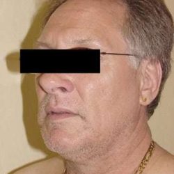 Facelift Before & After Patient #395