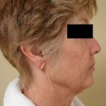 Facelift Before & After Patient #398