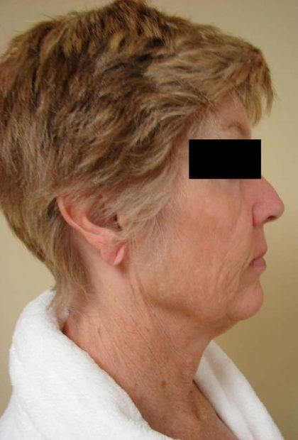 Facelift Before & After Patient #398