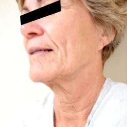 Facelift Before & After Patient #401
