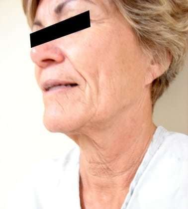 Facelift Before & After Patient #401