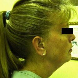 Facelift Before & After Patient #405