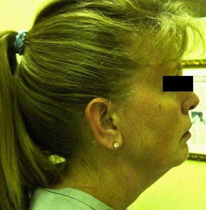 Facelift Before & After Patient #405