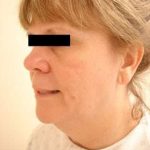 Facelift Before & After Patient #408