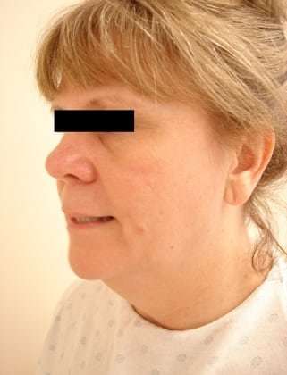 Facelift Before & After Patient #408