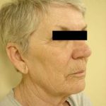 Facelift Before & After Patient #411