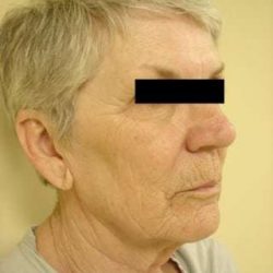 Facelift Before & After Patient #411