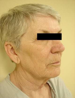Facelift Before & After Patient #411