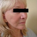 Facelift Before & After Patient #416