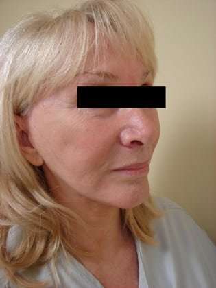 Facelift Before & After Patient #416