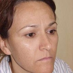 Laser Resurfacing Before & After Patient #149