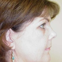 Brow Lift Before & After Patient #422