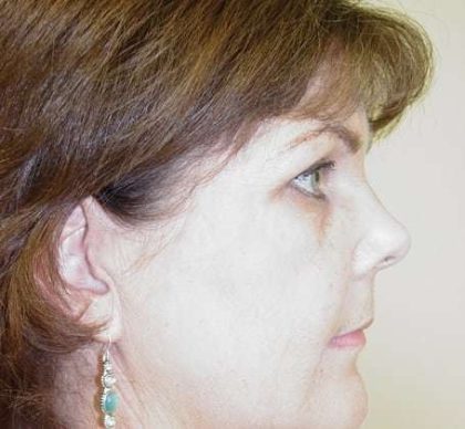 Brow Lift Before & After Patient #422