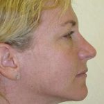 Brow Lift Before & After Patient #428